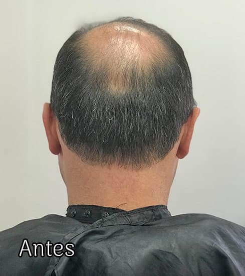 Protese-Capilar-masculino