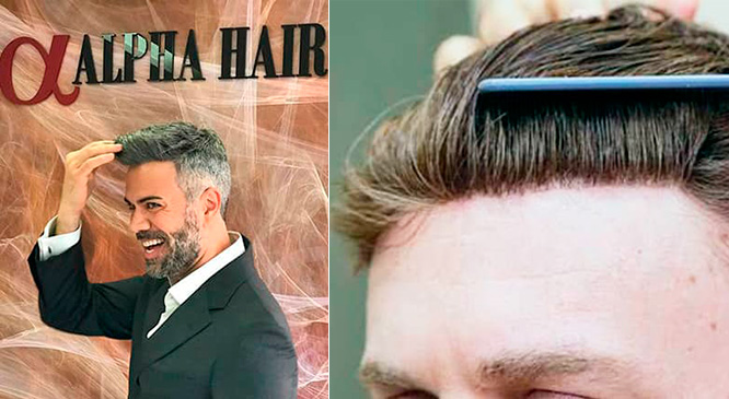 Prótese Capilar Masculino protese-capilar-masculino